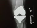 Diagnosing an Arthritic Knee Joint