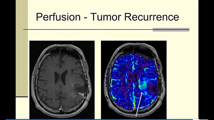 Brain Tumor Imaging Techniques: UCLA Brain Tumor Virtual Conference 2022