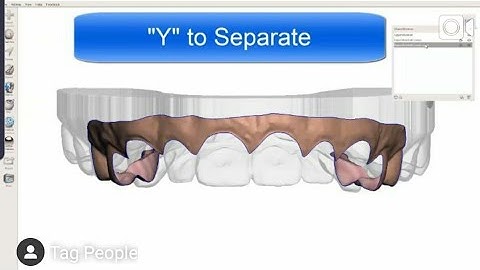 Digital Gingivectomy Guide