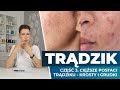 Saga o TRĄDZIKU. Część 3 - trądzik zaawansowany: ropne krosty, grudki, stany zapalne