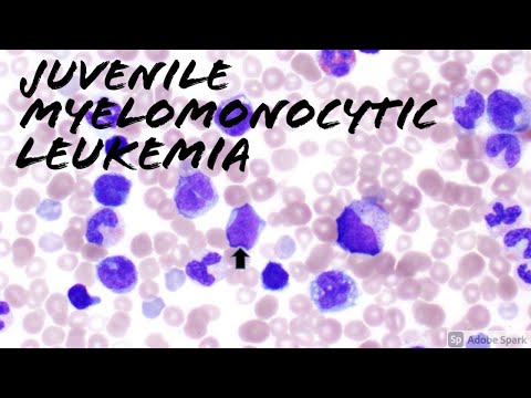 Juvenile Myelomonocytic Leukemia (JMML) Peripheral Blood Smear (2 year old). Hematology & Hemepath