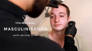 MASCULINISATION TREATMENT WITH FACIAL FILLERS | VIVA Skin Clinics