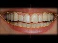 Esthetic Restorative Dentistry - Teaser Video