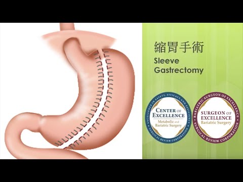 香港減重及糖尿外科中心 - 腹腔鏡縮胃手術  Laparoscopic Sleeve Gastrectomy