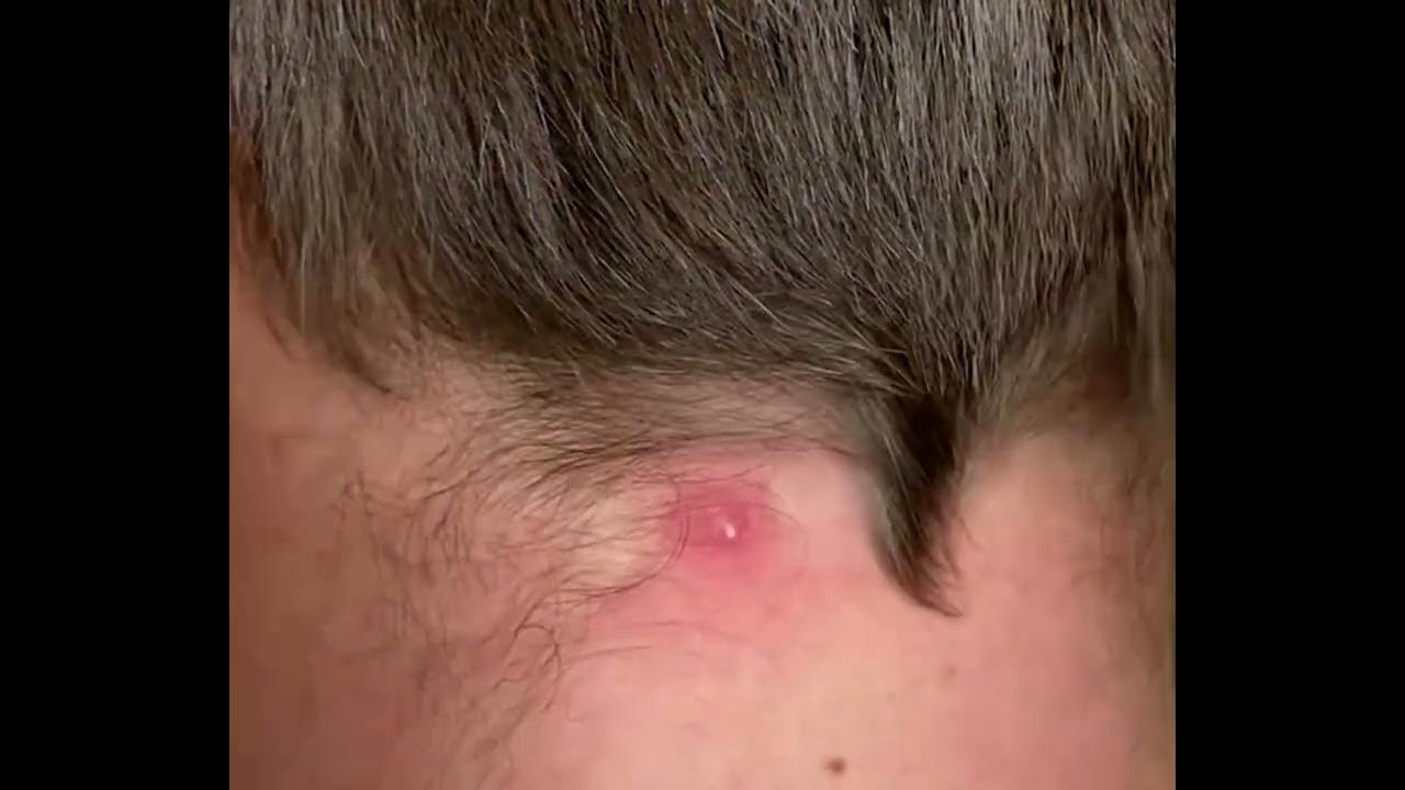 Blackheads loan nguyen 2022 Cystic acne and blackheads removal YouTube