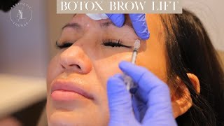 Botox Brow Lift