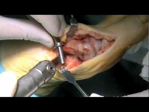 Cirugia de juanetes con tornillos