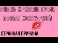 Кривые губы после #контурнаяпластикагуб Комки в губах.