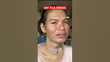 TCA CROSS Healing Stages | On Day 7 am not wearing foundation just lippy, brows & eyeshadows