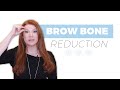 What is a Brow Bone Reduction