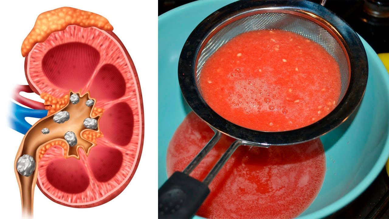How To Cleanse & Detox Your Kidneys Naturally YouTube