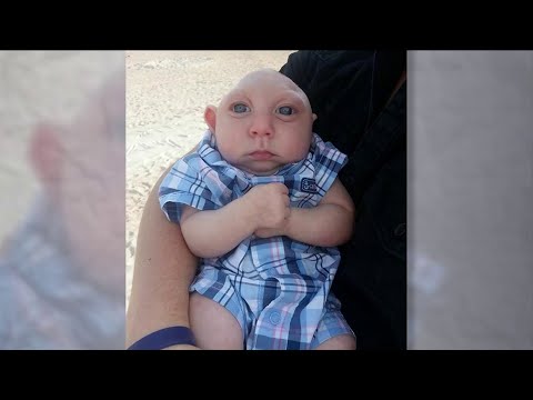 Video: Child Who Was Born With The Brain On The Outside Clings To Life VIDEO