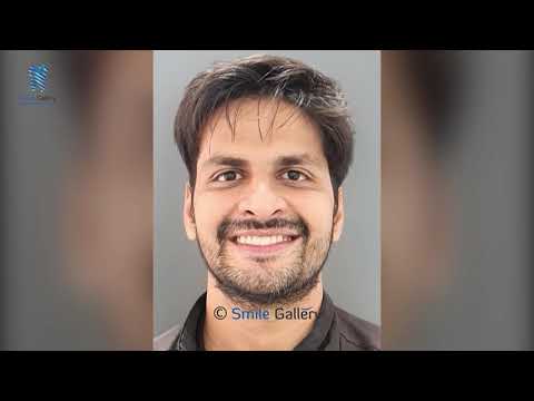 Video: Abhinav Ram's braces experience, patient testimonial at Smile Gallery