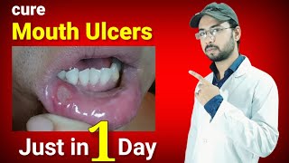 cure mouth ulcers just in one day permanently | mouth ulcer home remedy | canker sore home remedy