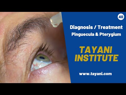 Video: Pterygium: Ursachen, Symptome Und Diagnose