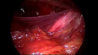 laparoscopic appendicectomy for stump appendicitis