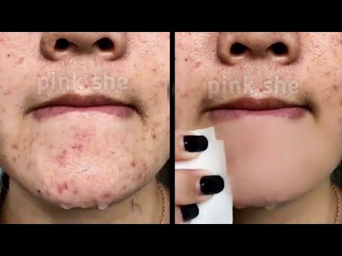 वीडियो: अपने चेहरे पर निशान कैसे ढकें: 10 कदम (चित्रों के साथ)