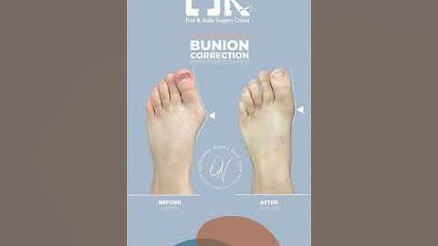 Painful Bunion  - Minimally Invasive Bunion Surgery