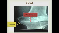 X-ray of Osteoarthritis in the knee