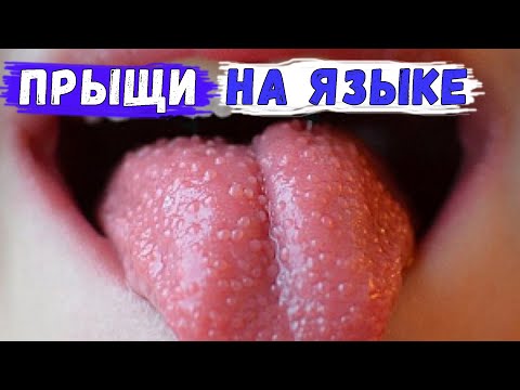 Почему появляются прыщи на языке и что с этим делать