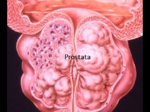 cistitis uretritis urólogo padovana