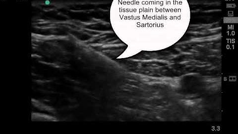 Saphenous Nerve Block in the Adductor Canal