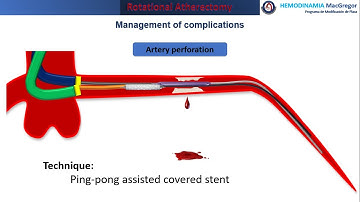 Ping-pong technique in coronary perforation