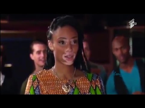 ვიტილიგოს დიაგნოზი და ცნობილი ადამიანები