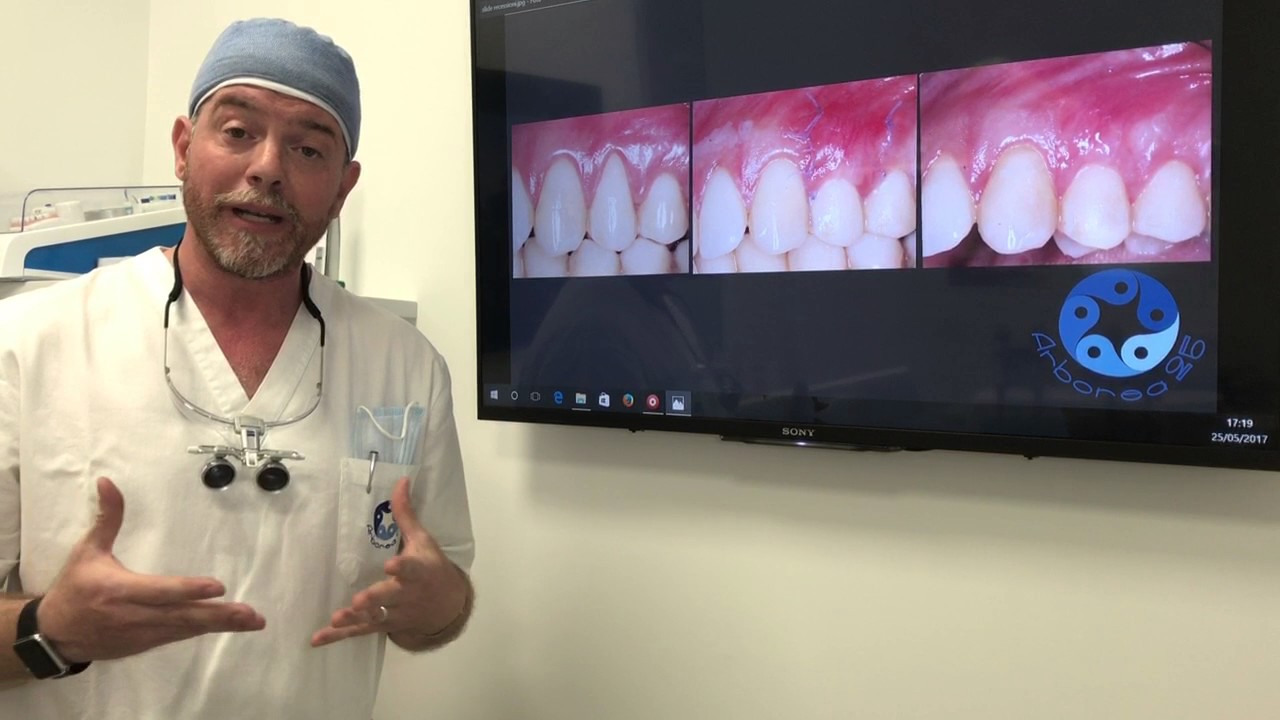 Recessione gengivale: da cosa dipende e quando intervenire?