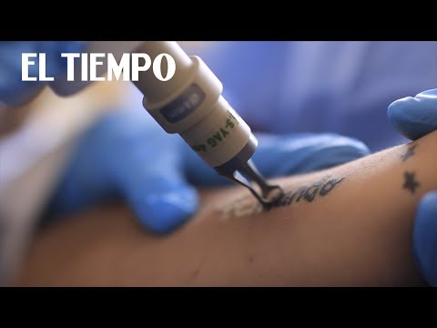 Vídeo: Eliminación De Tatuajes: Cómo, Costos, Fotos Antes Y Después Y Más