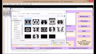 Details Lung Cancer Detection using Image Processing | Lung Cancer Classification Using Matlab News