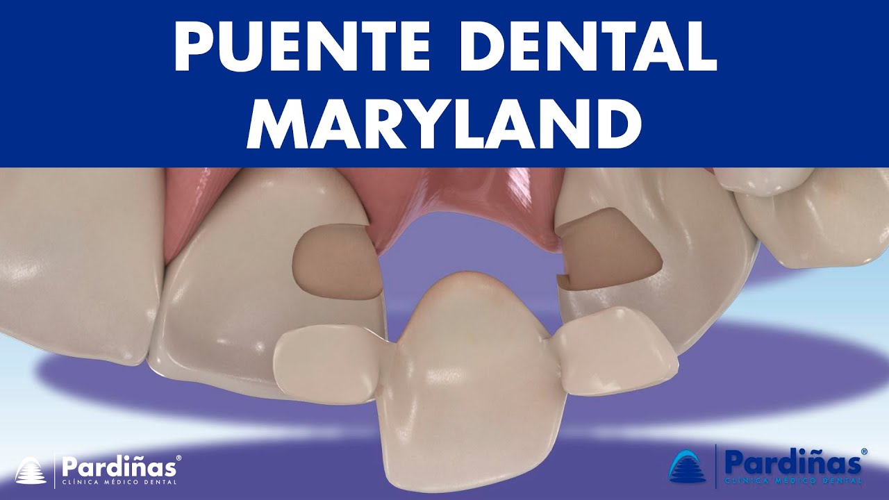 Puente MARYLAND Una alternativa de PUENTE DENTAL para los dientes