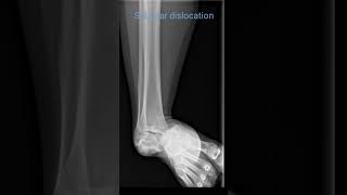 Subtalar dislocation