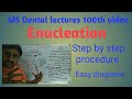 Cyst Enucleation