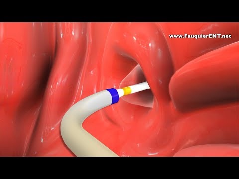 Balloon Eustachian Tube Dilation to Treat Eustachian Tube Dysfunction