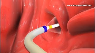 Balloon Eustachian Tube Dilation to Treat Eustachian Tube Dysfunction screenshot 5