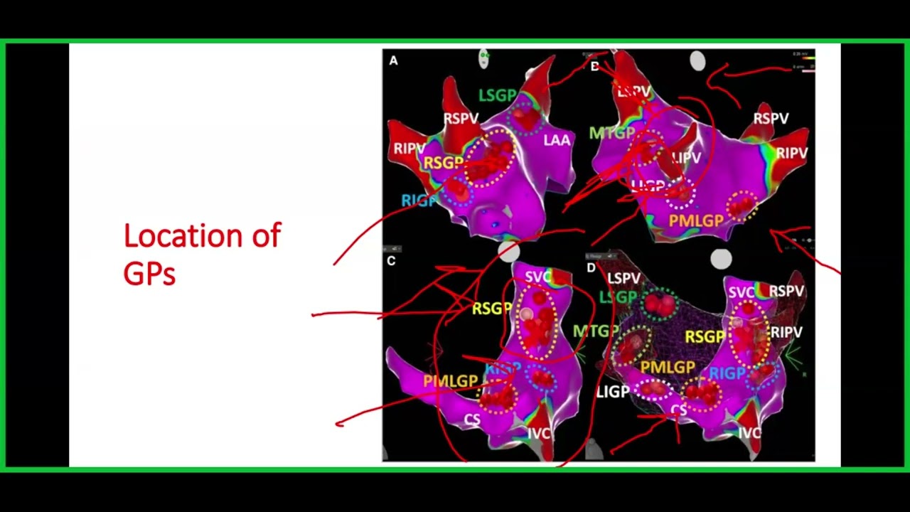 Cardioneuroablation Technique By Ahmad Rossasy, Msc