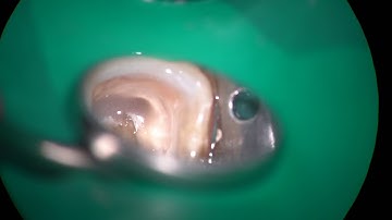 10119 BFR Ledge bypassing and BC obturation