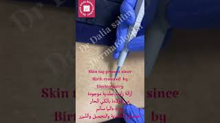 skin tag removal by electrocautry   - الكي الحار  لالزوائد الجلدية