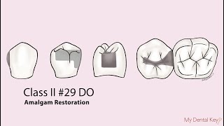 Class II amalgam restoration || My Dental Key
