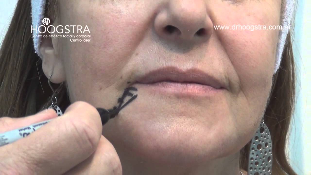 relleno para puff Relleno de Surcos Faciales (13006)