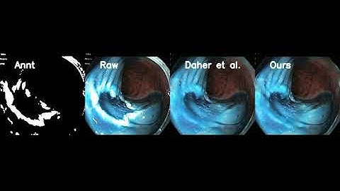 MICCAI 2024 - Depth-Aware Endoscopic Video Inpainting