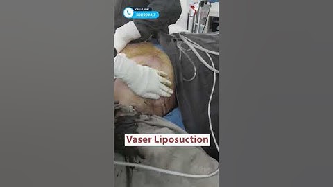 Gynecomastia Grade 3a Surgery  | 360° Treatment By Dr. Amit Gupta