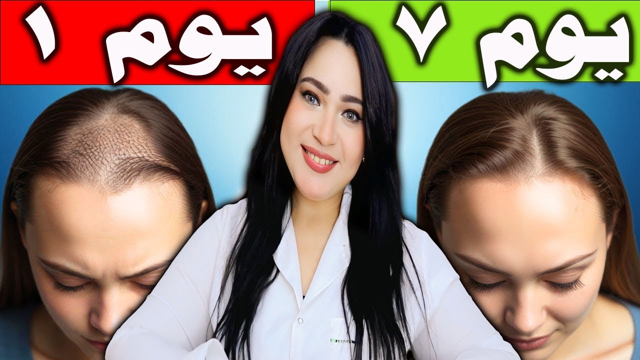 لو بتخسري شعرك خصلة ورا التانية .. الفيديو ده هينقذك في 7 أيام !!
