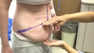 ⁣Teen gets tummy tuck to remove 'hang'