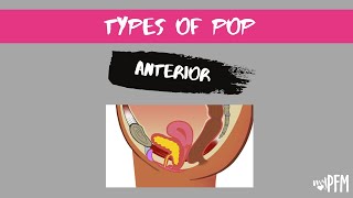 Anterior L Wall Prolapse Cystocele