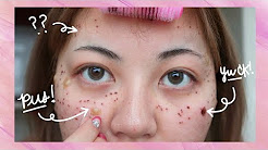 Results of ACNE LASER TREATMENT! Before + After!