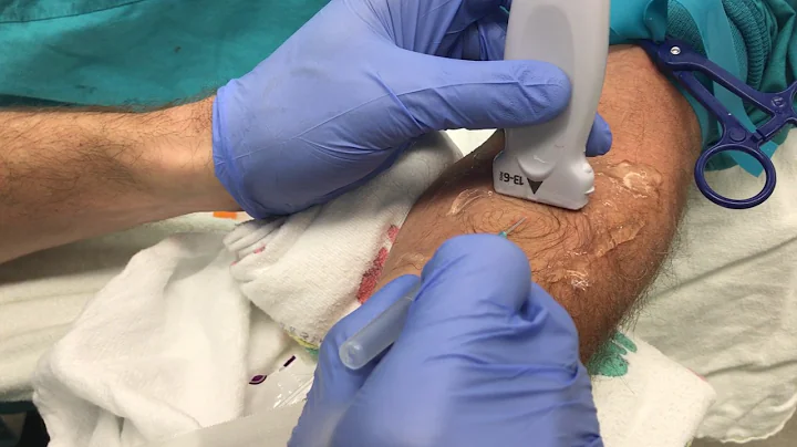 Ultrasound Guided Peripheral IV Insertion - "Out-of-plane" Approach