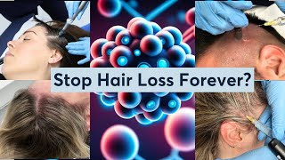 Why is Exosome Hair Restoration So Popular Now?