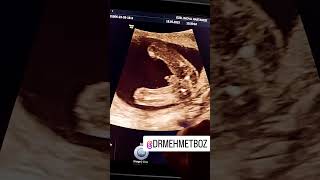 Erkek Bebegimiz. Ci̇nsi̇yet Tespi̇ti̇ 17. Hafta Gebelik. Dr. Mehmet Boz 2023